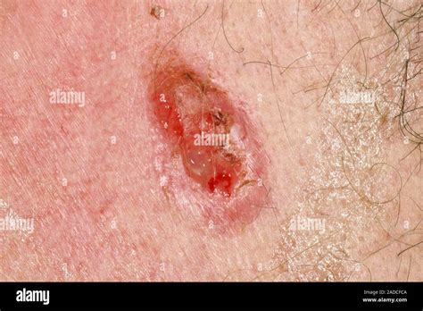Nodular Infiltrative Basal Cell Carcinoma Skin Cancer Close Up Of A