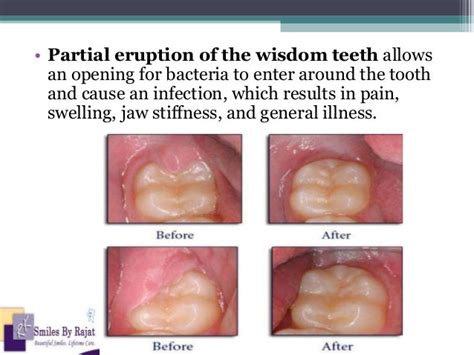 Atraumatic Wisdom Teeth Extraction Impacted Teeth Extraction Oral