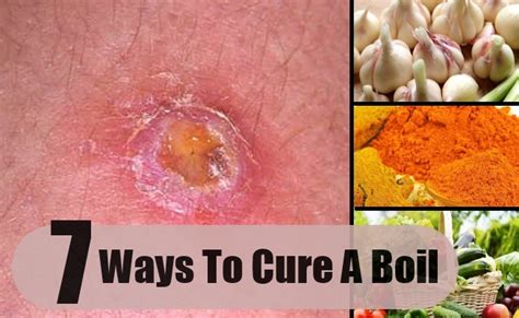 How To Cures A Boil Effective Ways To Cure A Boil Find Home Remedy