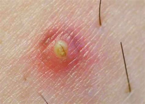 Ingrown Hair On Thigh Pictures Causes And Treatment
