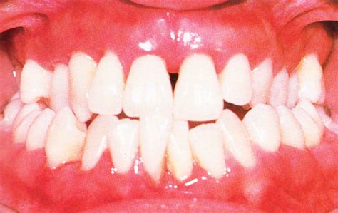 Gum Disease Periodontitis Prestige Dental My