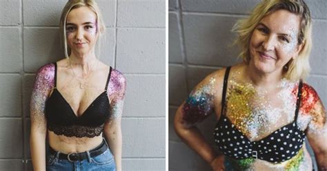 Women Celebrate Scars Burns And Imperfections With Body Positive