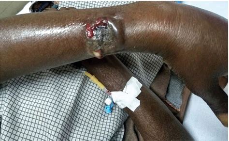 Cutaneous Anthrax In A Tribal Man A Case Report Postgraduate Medical