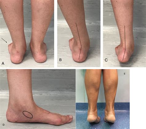 Flatfoot Deformity Due To Isolated Spring Ligament Injury The Journal
