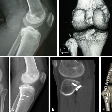 Posterior Medial Approach In Treating Posterior Tibial Plateau Images