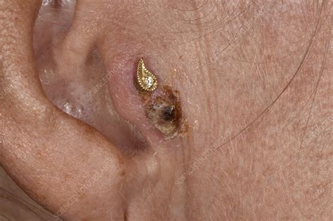 Infected Ear Piercing Stock Image C0472802 Science Photo Library