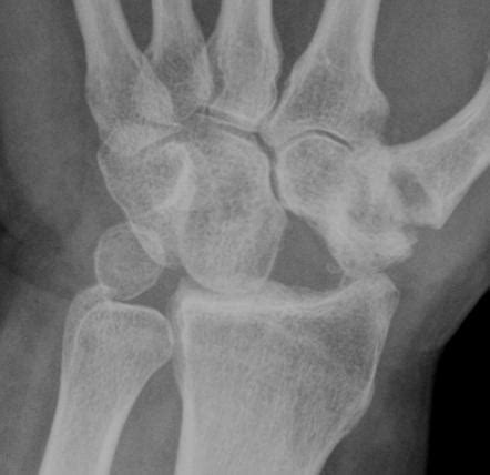 However, it has a disadvantage of relative lengthening of extrinsic tendons. Image | Radiopaedia.org