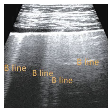 Ultrasound Signs Of The Lungs With Different Scores Note In Figure