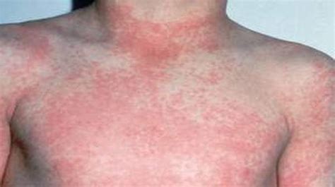 Scarlet Fever Overview And Rash Look Like