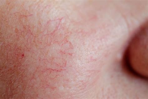 Peau grise et cendrée chez les personnes ayant un teint foncé. Rosacée (couperose) : symptômes, diagnostic, stades et ...