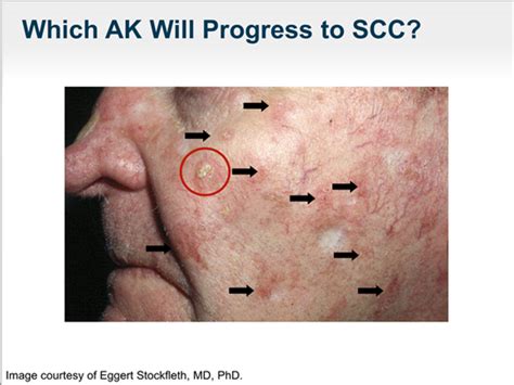 Actinic Keratosis And Field Cancerization New Insights Transcript