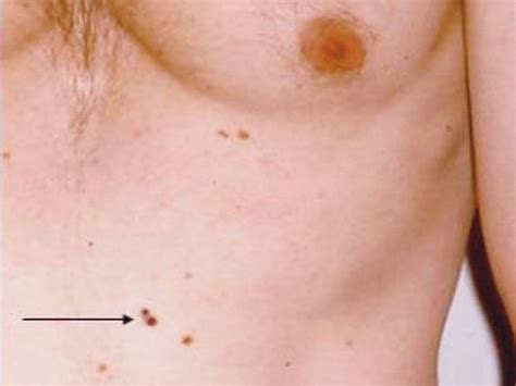 Skin Cancer Warning Signs What Skin Cancer Looks Like
