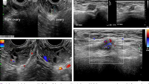 Figure 1 From Inguinal Endometriosis In A Patient Without A Previous
