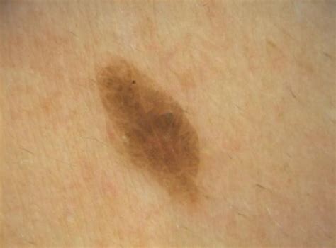 Seborrheic Keratoses The Most Common Benign Skin Tumor Of Humans