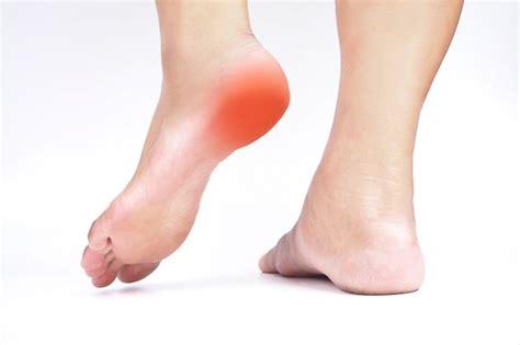 Penatalaksanaan Plantar Fasciitis Alomedika