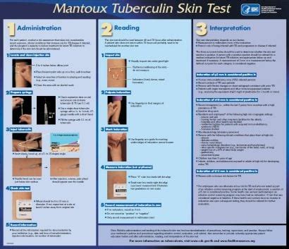 Cdc Tb Skin Test Form