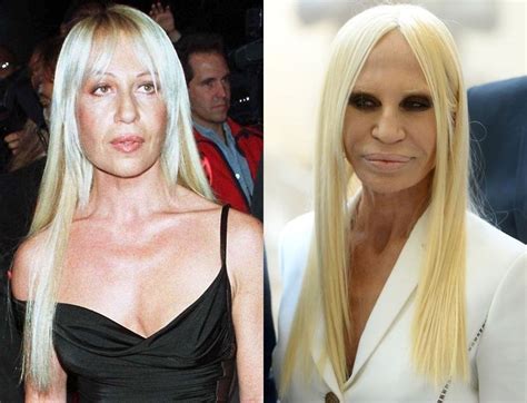 Donatella Versace A Before And After Celebrity Plastic Surgery