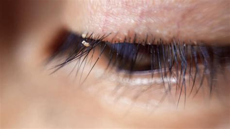Doctors Warn About Dangers And Spread Of Eyelash Lice