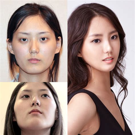 Koreanische Mädchen Plastische Chirurgie Hoher Kalifornien