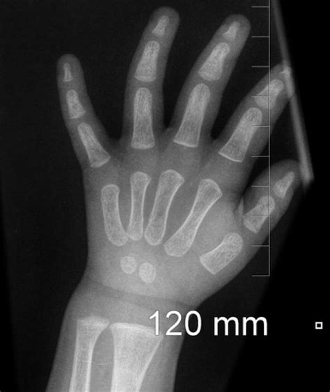 Normal Wrist And Hand X Ray 2 Year Old Image