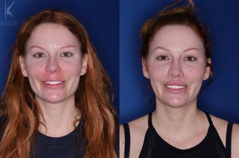 interview elite atlanta facial plastic surgeon ben stong brings a new aesthetic to the lip lift