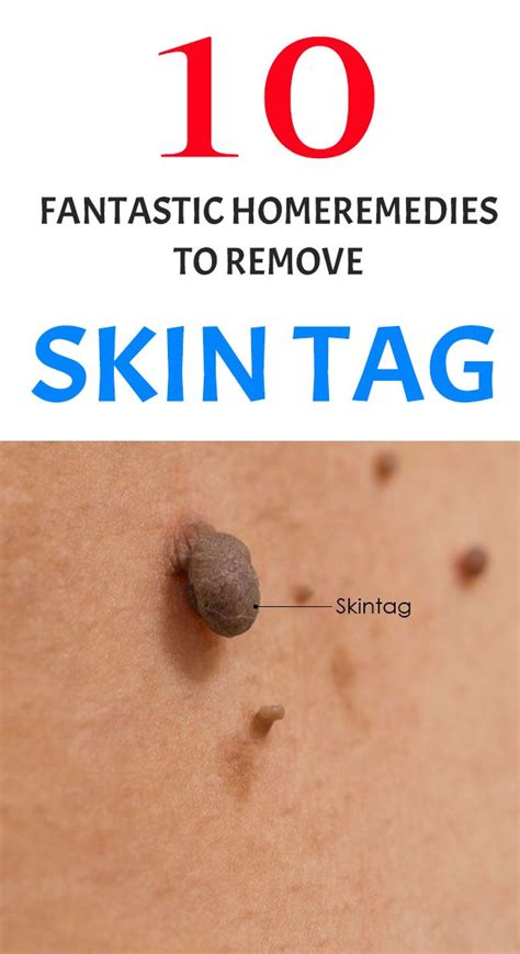 top 10 home remedies to remove skin tags naturally remove skin tags naturally skin tag