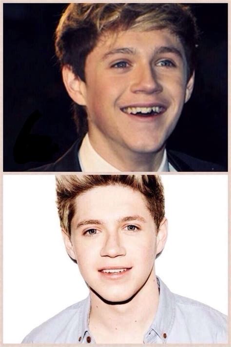 Niall Looks Cute Both Before And After Braces I Love One Direction One Direction My Love