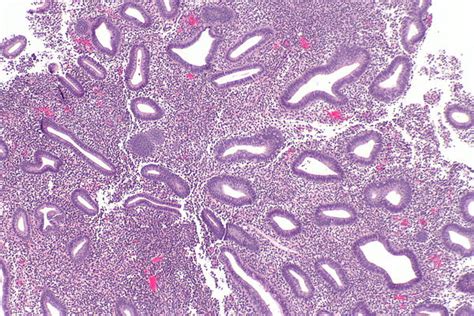 Disordered Proliferative Endometrium Libre Pathology