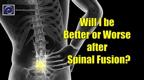 Spinal Fusion Before And After