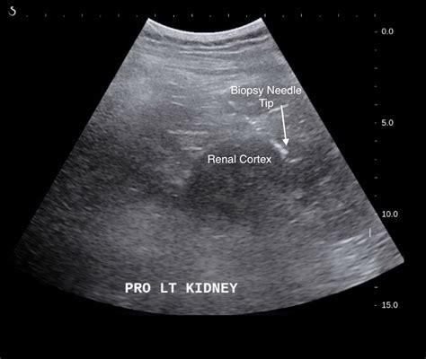 Interventional Radiology Procedures Ultrasound Guided Non Focal Renal