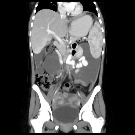 Tuberculous Peritonitis And Tubo Ovarian Abscesses Radiology Case Radiopaedia Org
