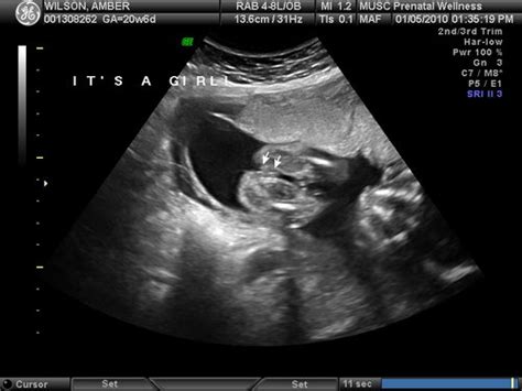 Ultrasound Pics Of Baby Showing Off Gender Babycenter