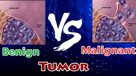 Benign Tumor Vs Malignant Tumor Clear Comparison Youtube