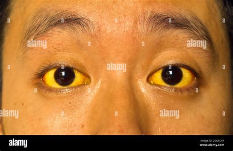 Deep Jaundice In Asian Male Patient Yellowish Discoloration Of Skin
