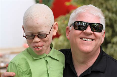Champion For People With Albinism In Africa Visits Australia Impress
