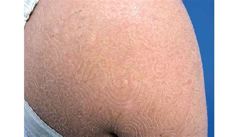 Fungal Infection On Leg Candida Skin Fungus Medical Pictures Info