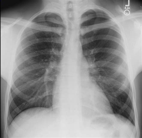 Best Of Finding Rib Fractures On Chest X Ray The Trauma Pro