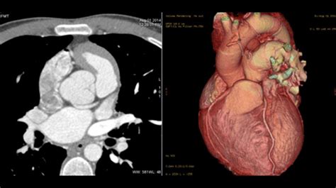 Congenital Heart Disease And Pediatric Cardiology American College Of