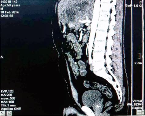 Vietnamese Medic Ultrasound Case 236 Lymphoma Mimicking Pancreatic
