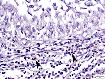 A tumor marker is anything present in or produced by cancer cells or other cells of the body in response to cancer or certain benign (noncancerous) conditions that provides information about a cancer, such as how aggressive it is, what kind of treatment it may respond to, or whether it is responding to treatment. Neutrophil-to-lymphocyte ratio is a prognostic marker in ...