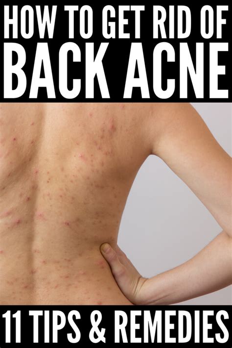 How To Get Rid Of Back Acne 11 Tips And Remedies That Work