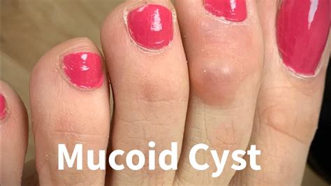 Surgical Removal Of Digital Mucoid Cyst In The Toe Akron Podiatrist