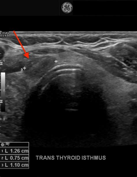 Isthmus Thyroid Ultrasound