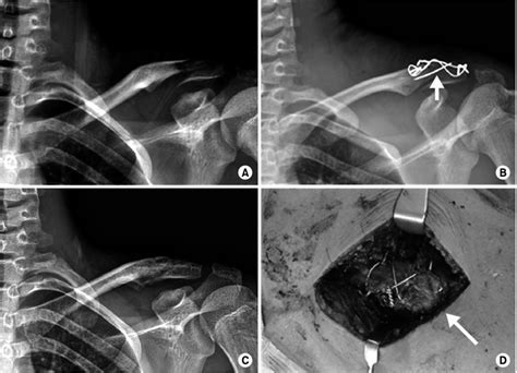 A A 16 Year Old Male Sustained A Neer Type Iib Left Distal Clavicle