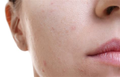 Adult Acne How To Treat And Manage This Common Skin Complaint The