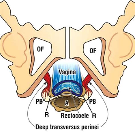 Pdf Transvaginal Perineal Body Repair For Low Rectocele