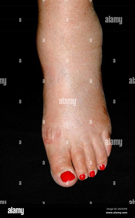 Swelling Oedema Of The Ankle In A 79 Year Old Female Patient A Side