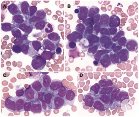 Hepatosplenic T Cell Lymphoma Mimicking Bone Marrow Metastasis
