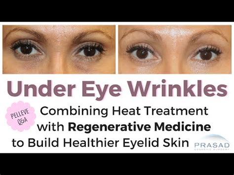 Anmerkung Verfault Verwickle Dich Laser Treatment For Eye Wrinkles Neuheit Hierarchie Diktat