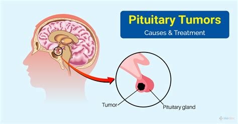 pituitary tumor types symptoms and treatment options